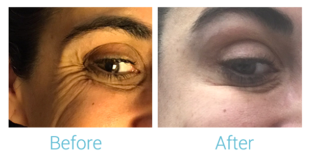 Fillers Before & After Gallery - Patient 58152125 - Image 2