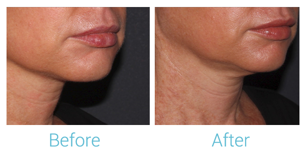 Fillers Before & After Gallery - Patient 58152127 - Image 2