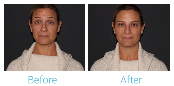 Neurotoxins (Botox, Dysport, Xeomin) Before & After Gallery - Patient 58152149 - Image 1