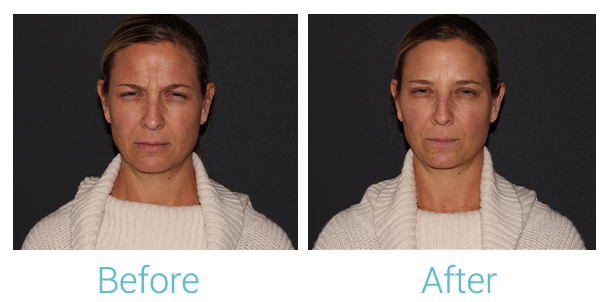 Neurotoxins (Botox, Dysport, Xeomin) Before & After Gallery - Patient 58152149 - Image 2