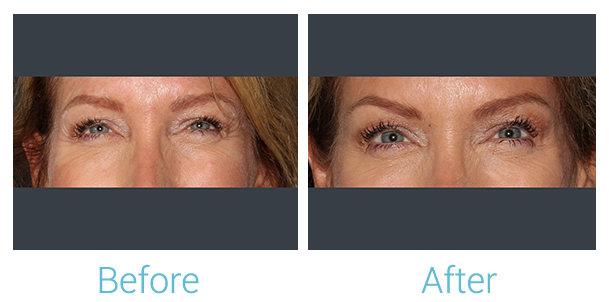 Neurotoxins (Botox, Dysport, Xeomin) Before & After Gallery - Patient 58152150 - Image 1