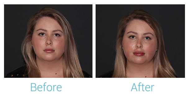 Fillers Before & After Gallery - Patient 154108521 - Image 1