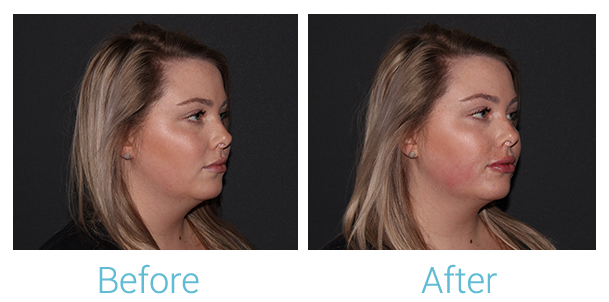 Fillers Before & After Gallery - Patient 154108521 - Image 3