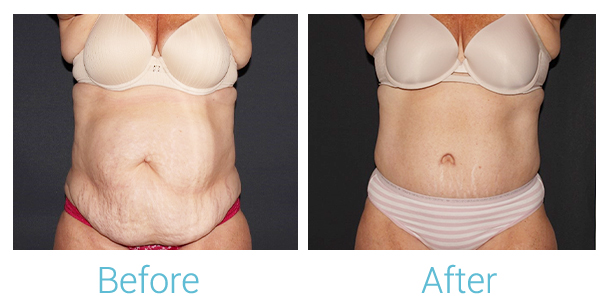 Tummy Tuck Before & After Gallery - Patient 106048626 - Image 1