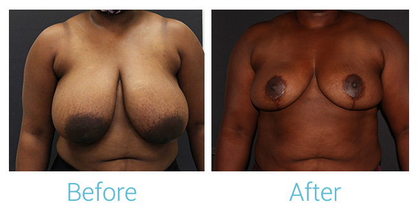 Breast Lift Before & After Gallery - Patient 141443879 - Image 1