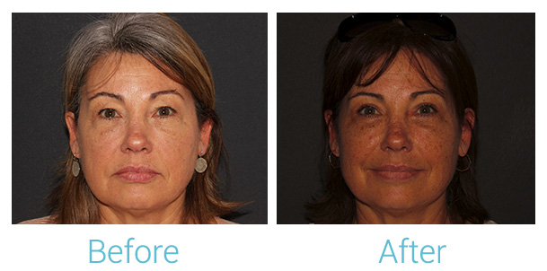 Eyelid Surgery Before & After Gallery - Patient 141444115 - Image 1
