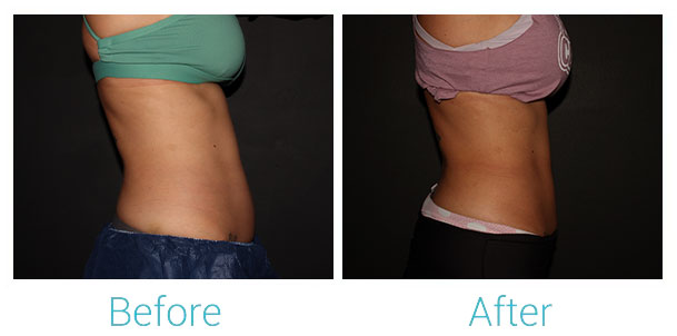 CoolSculpting Before & After Gallery - Patient 141470947 - Image 2