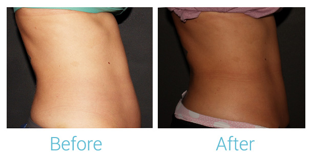 CoolSculpting Before & After Gallery - Patient 184933434 - Image 2