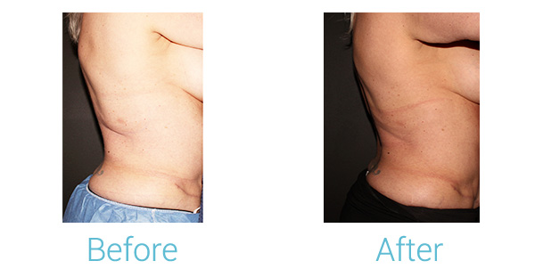 CoolSculpting Before & After Gallery - Patient 184933433 - Image 2