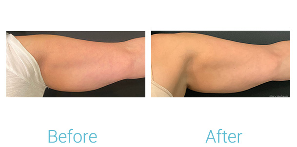 CoolSculpting Before & After Gallery - Patient 184933432 - Image 1