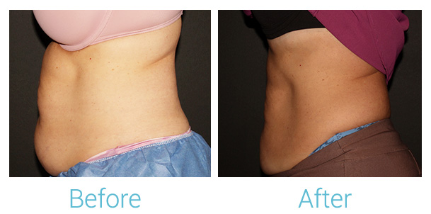 CoolSculpting Before & After Gallery - Patient 184933435 - Image 2