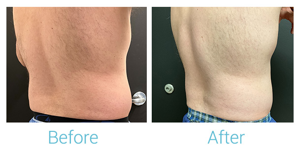 CoolSculpting Before & After Gallery - Patient 184933431 - Image 2