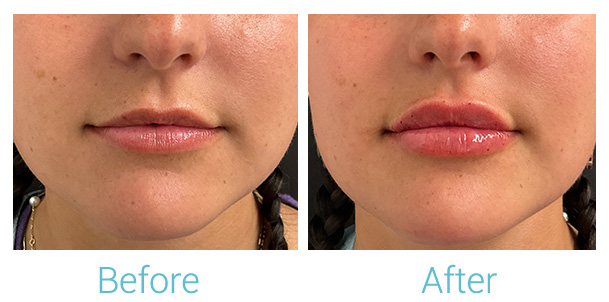 Fillers Before & After Gallery - Patient 184933305 - Image 1