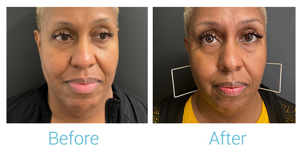 Morpheus8 Before & After Gallery - Patient 184933383 - Image 1