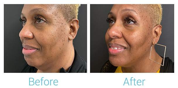 Morpheus8 Before & After Gallery - Patient 184933383 - Image 3