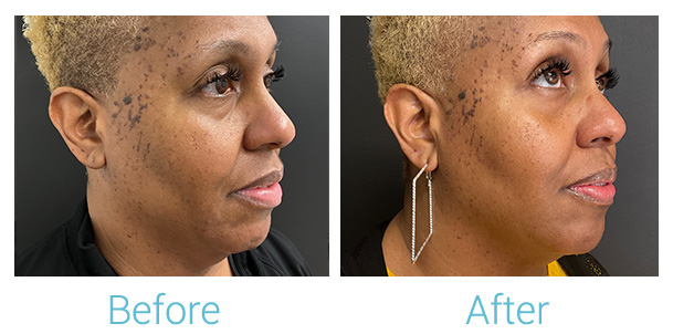 Morpheus8 Before & After Gallery - Patient 184933383 - Image 2