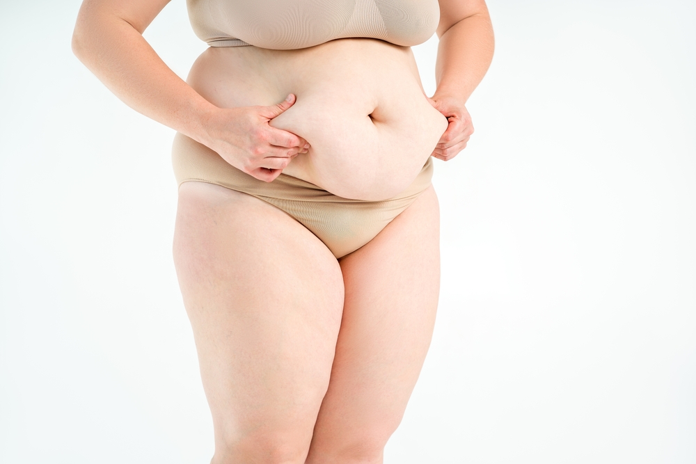 Tummy Tuck