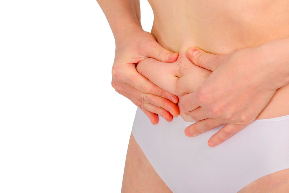 Tummy Tuck