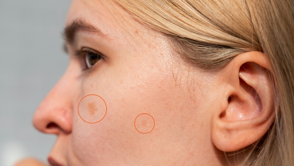 IPL Photofacial Treatments in Bel Air, MD: 5 Ways They Fade Sun Damage