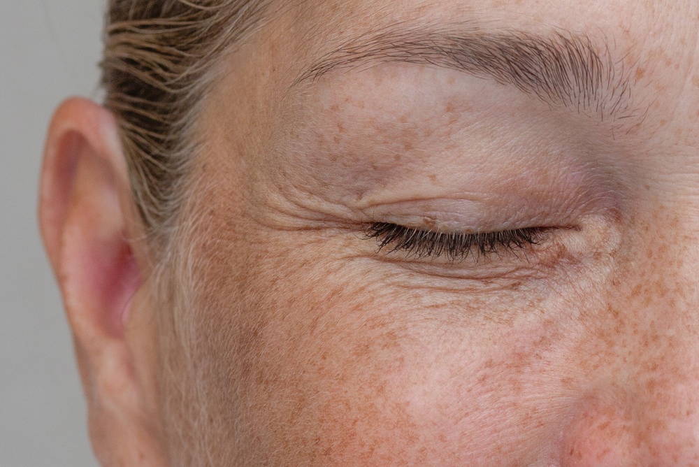 IPL Skin Rejuvenation Near Lutherville, MD: Your Solution for Age Spots and Rosacea